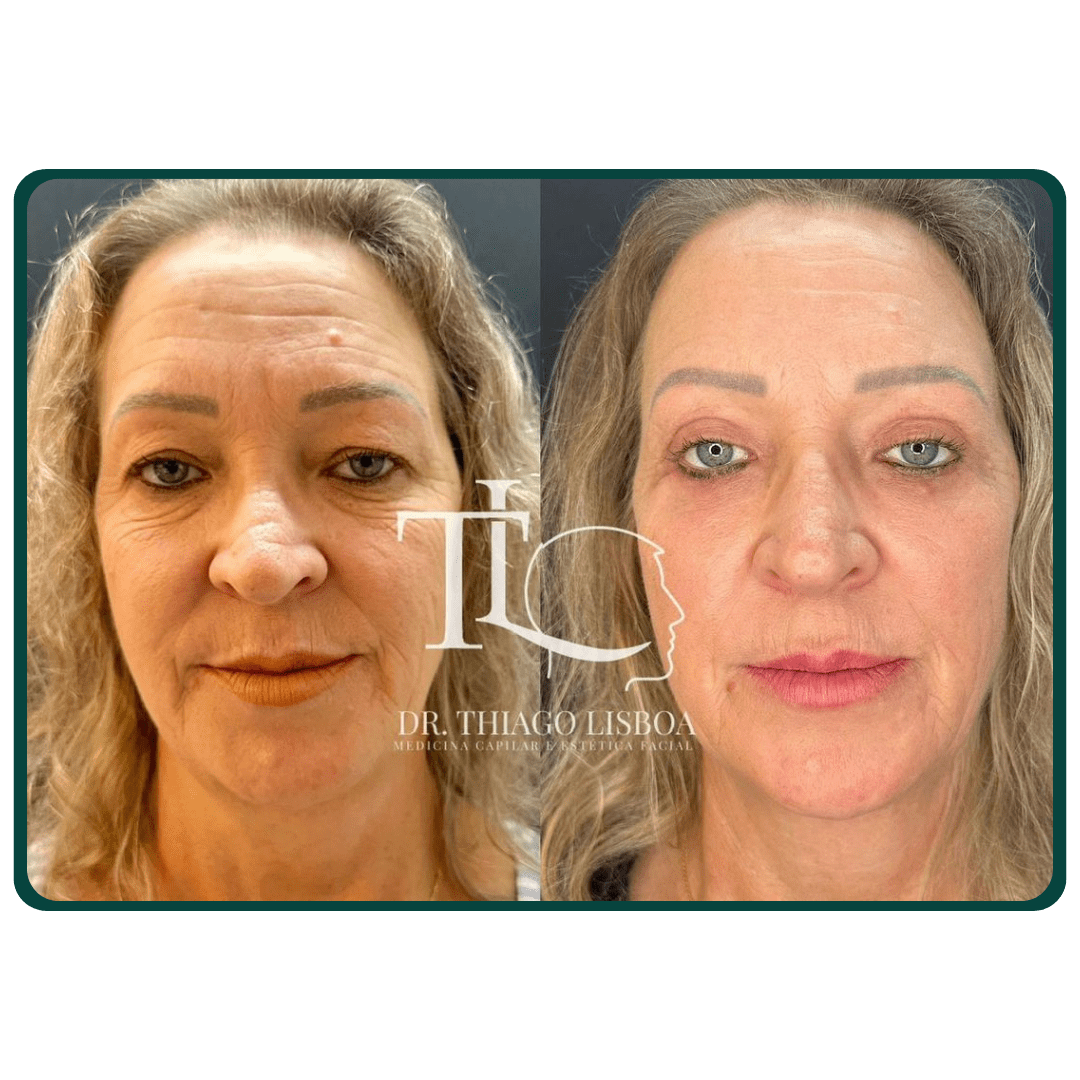 Blefaroplastia - Pálpebra superior