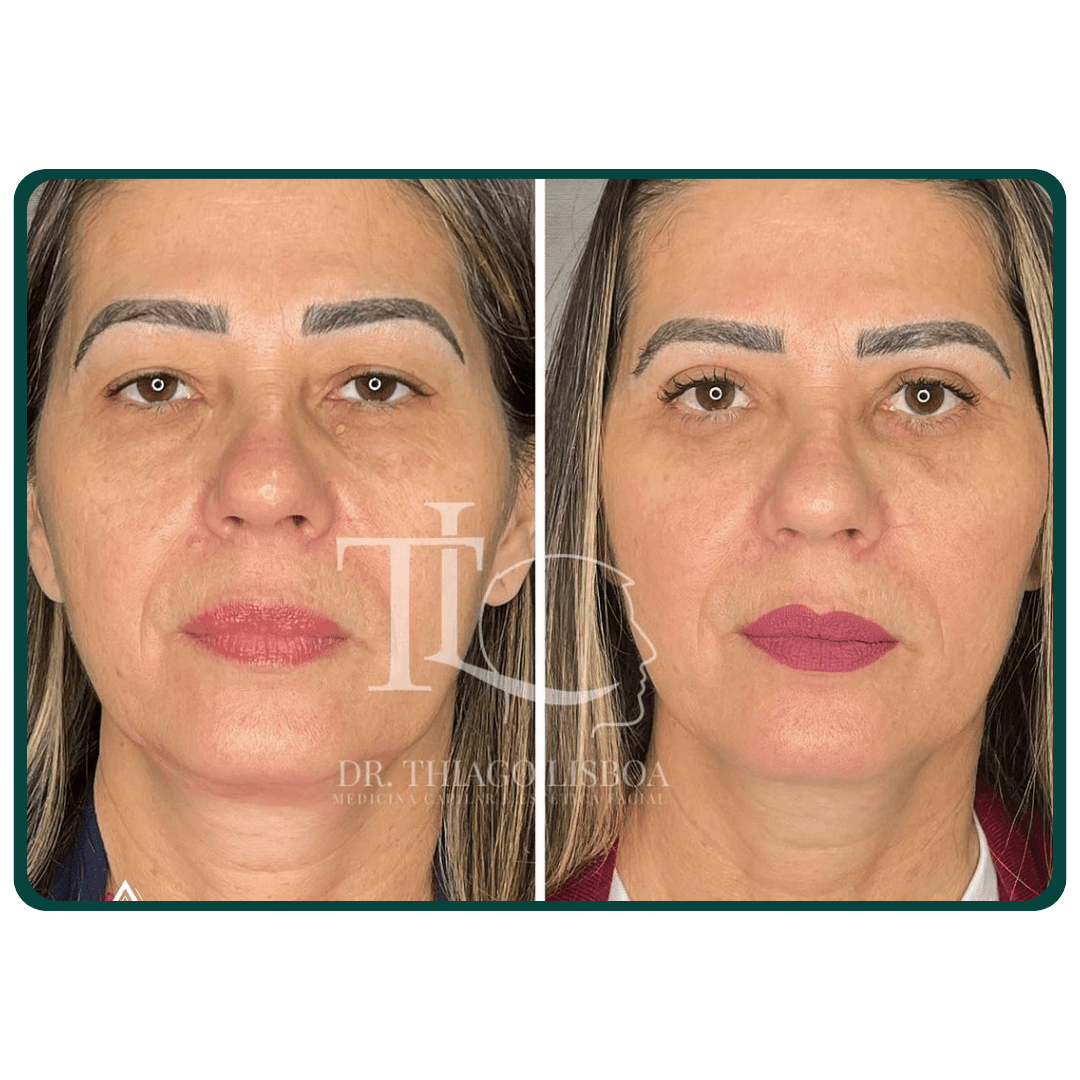 Blefaroplastia  - Pálpebra superior