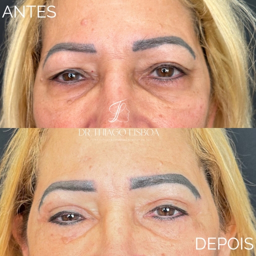 Blefaroplastia (2)