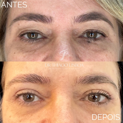 Blefaroplastia (3)