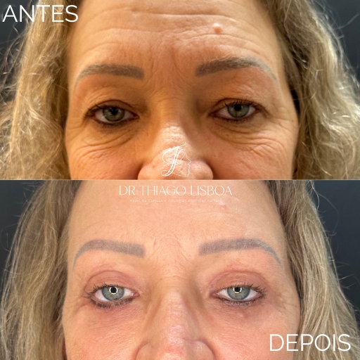 Blefaroplastia (5)