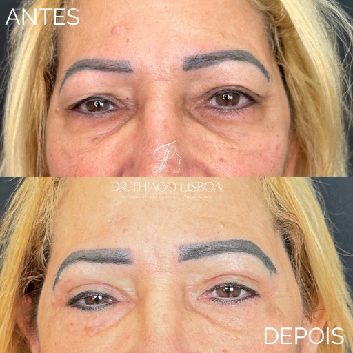 Blefaroplastia (6)