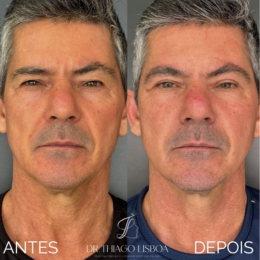 Blefaroplastia