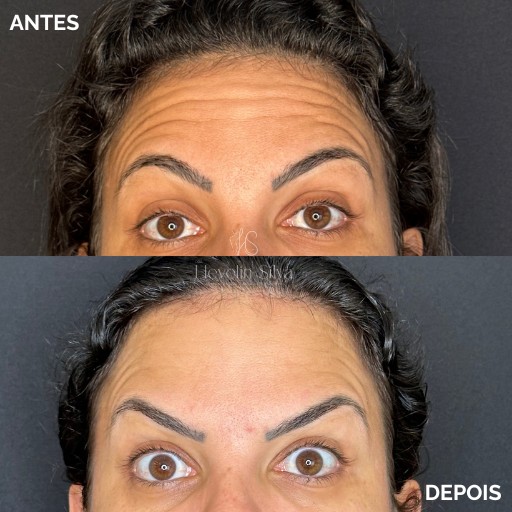 Botox (9)